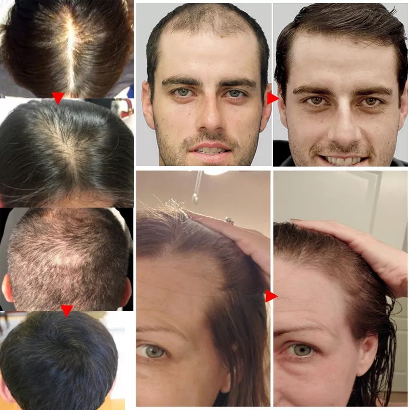 Aceite de biotina 2023 para el - Epidermal Growth Factor reseña y precio